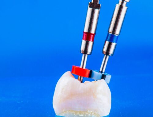 How Safe is Root Canal Treatment?