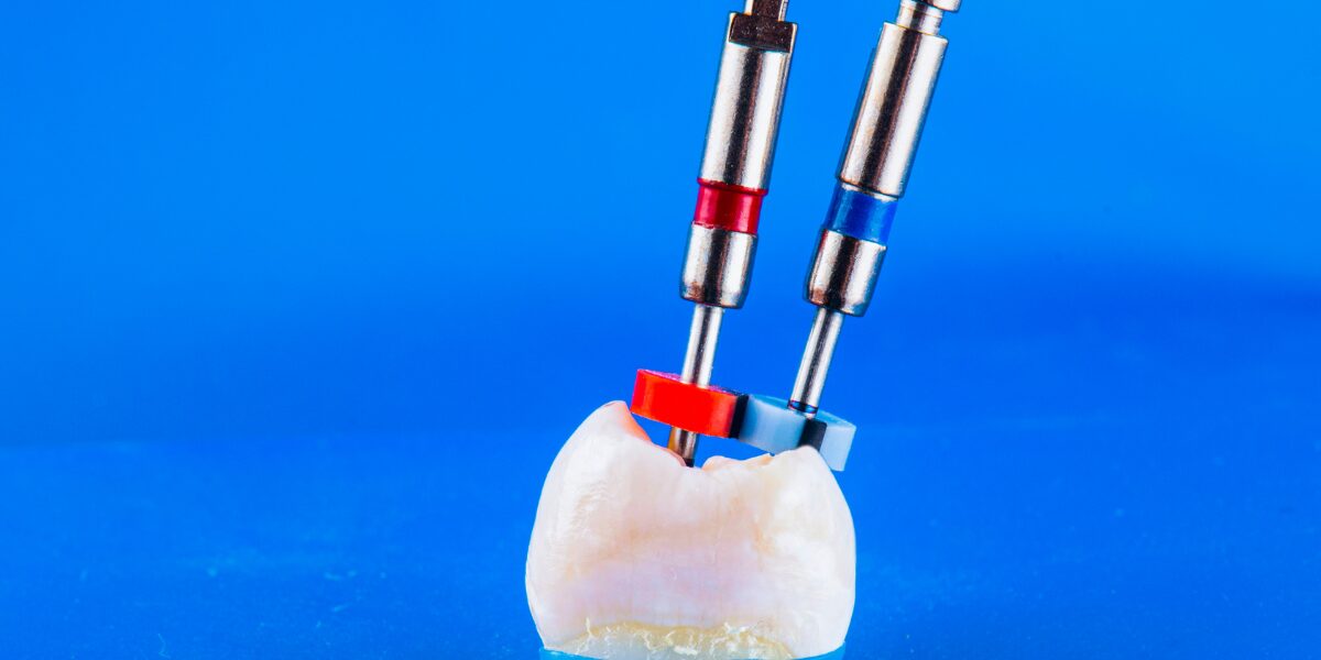 "Close-up of a tooth model with endodontic tools used in root canal treatments, displayed against a blue background.